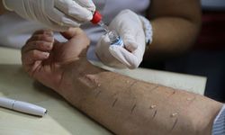 Türkiye'de toplumun yüzde 20'si alerjik belirtiler gösteriyor