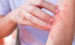 Egzama Nedir? Belirtileri ve Etkili Tedavi Yöntemleri
