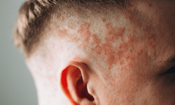 Sedef Hastalığı (Psoriasis) Nedir? Belirtileri ve Tedavi Yöntemleri