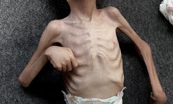 UNICEF: Gazze’de Her 5 Çocuktan 1’i Akut Yetersiz Beslenme Yaşıyor