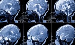 Yenidoğanlarda beyin hasarı erken tespit edilebilecek