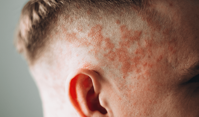 Sedef Hastalığı (Psoriasis) Nedir? Belirtileri ve Tedavi Yöntemleri