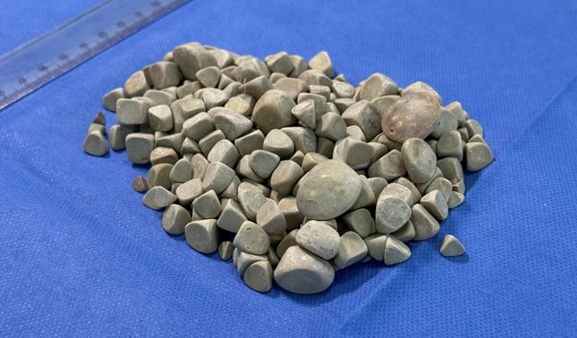 Karın ağrısı ile hastaneye başvurdu: Vücudundan 287 taş çıktı